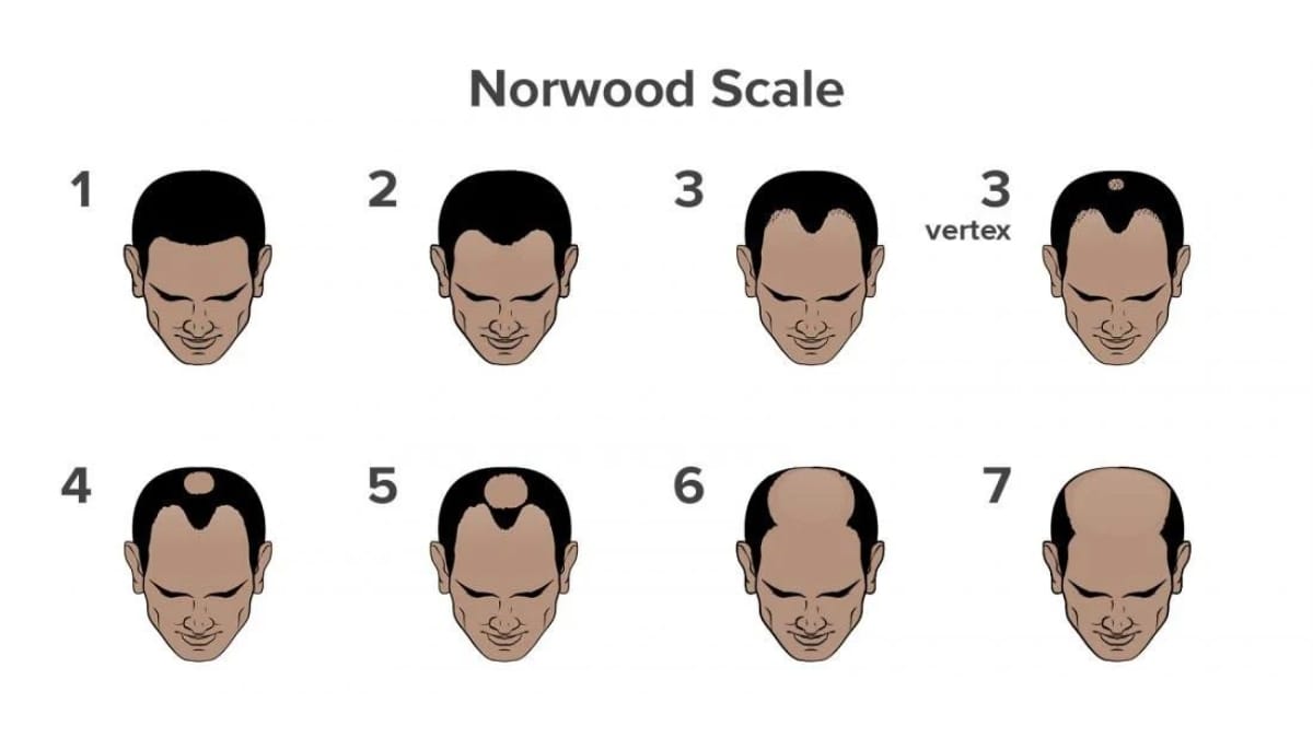 What-is-Causing-Your-Hair-Fall-Take-This-Scientifically-Backed-Hair-Loss-Quiz-NW